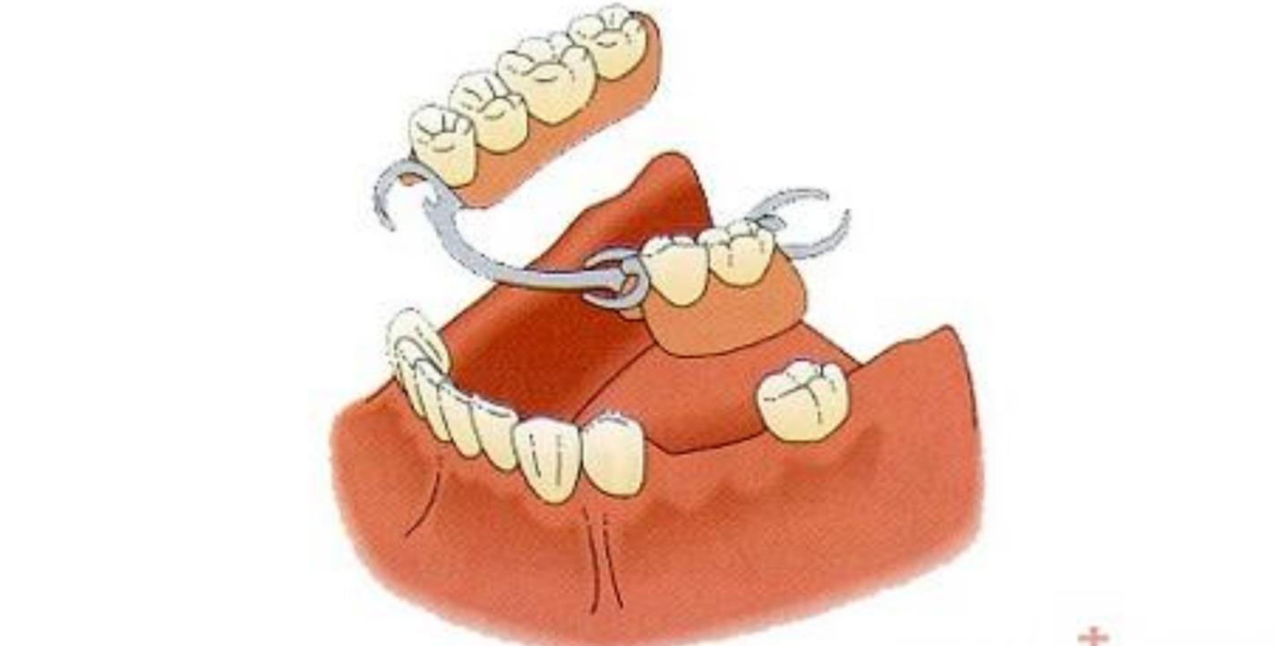 活动假牙_假牙活动了还能固定一下吗_假牙活动支架图片大全
